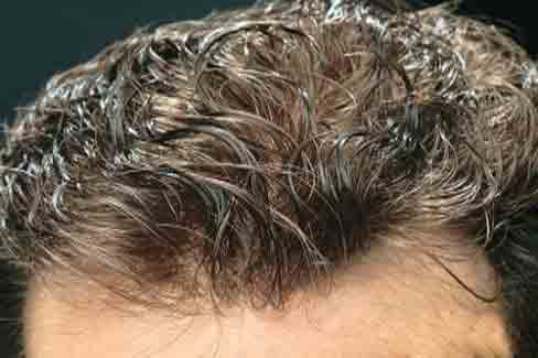 درمان چربی مو سر