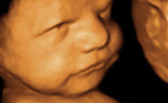 خطرات و عوارض سونوگرافی سه بعدی و چهار بعدی برای جنین